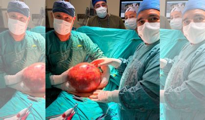 Doktorlar Gözlerine İnanamadı: 1,5 Yıl Ertelediği Ameliyatta Karnından Dev Kitle Çıktı