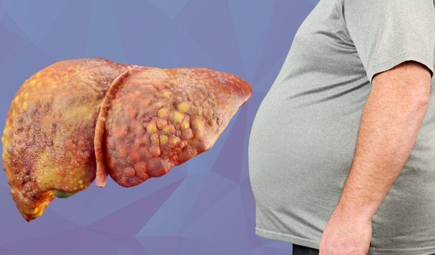 Karaciğer Yağlanması Siroz Ve Kanser Riskini Artırabilir